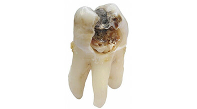 Tooth Decay Cavity
